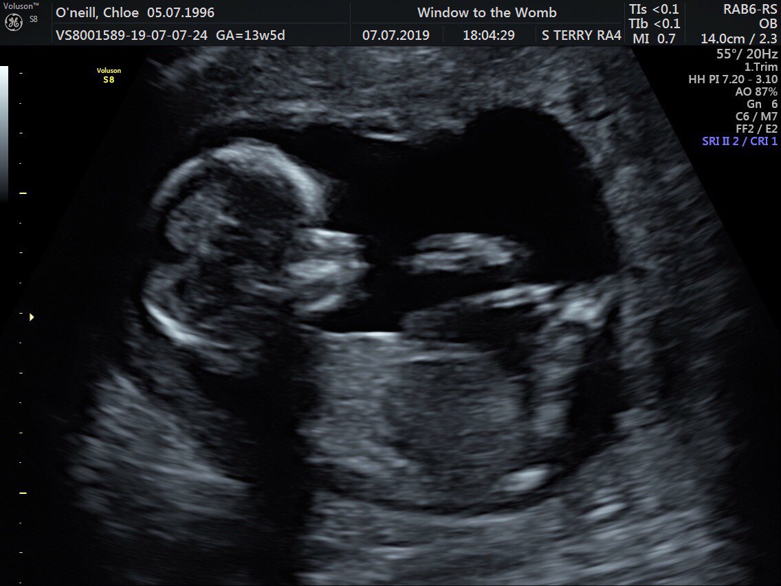 14 Week Scan Photos Any Guesses