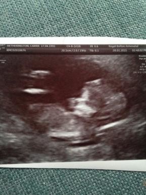 Any Gender Guesses With Week Scan