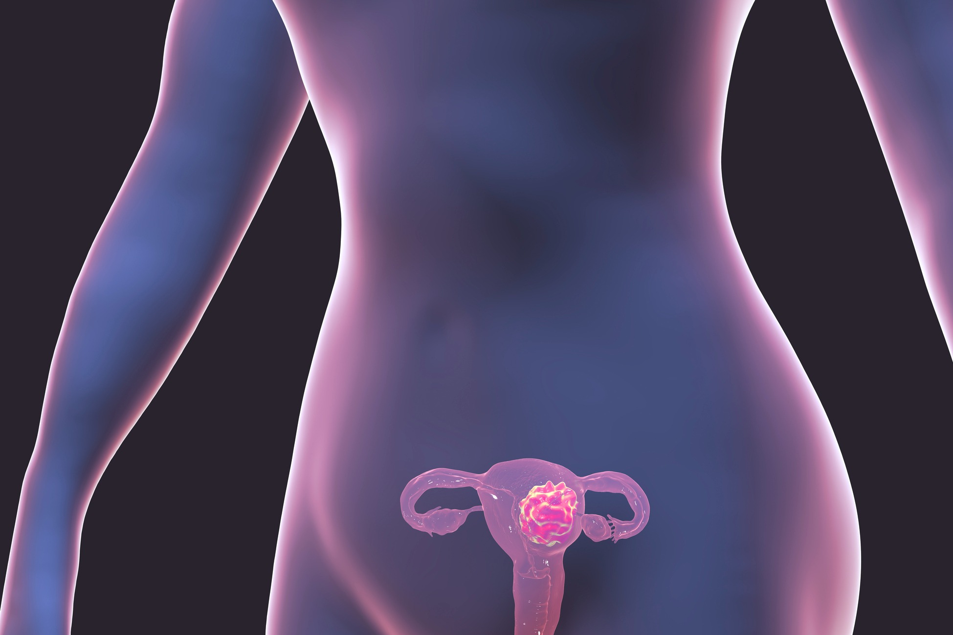 Les tumeurs de l'ovaire : cancers et kystes de l'ovaire ...