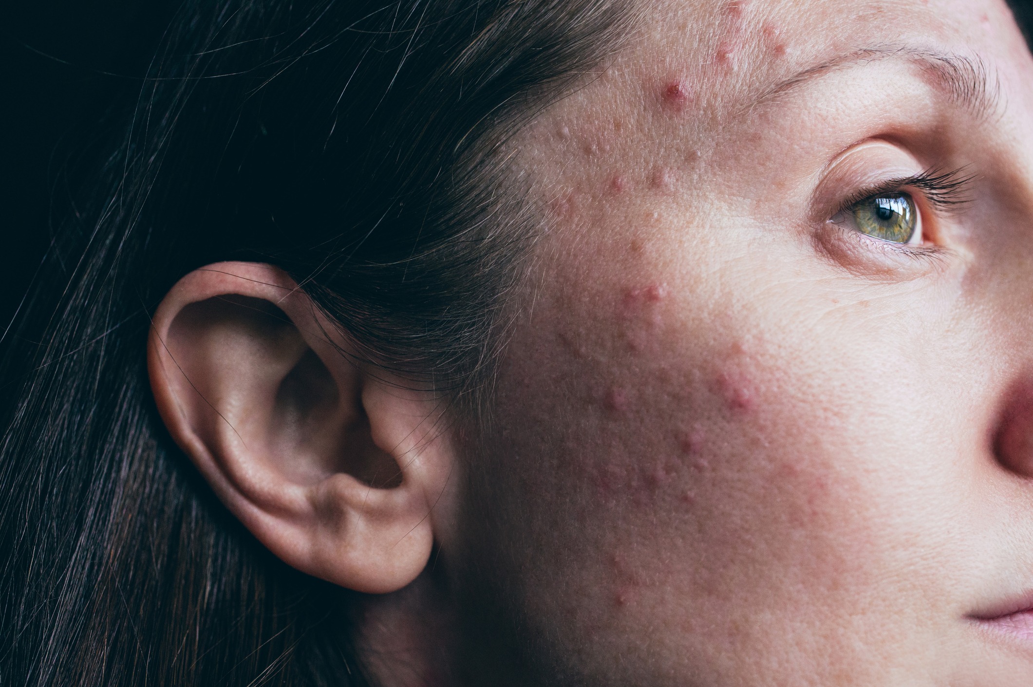 Acné : les traitements efficaces contre l'acné - Doctissimo