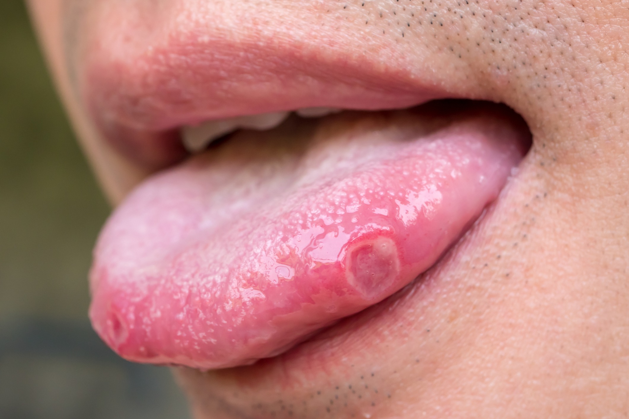 Bouton sur la langue : causes et traitements ?