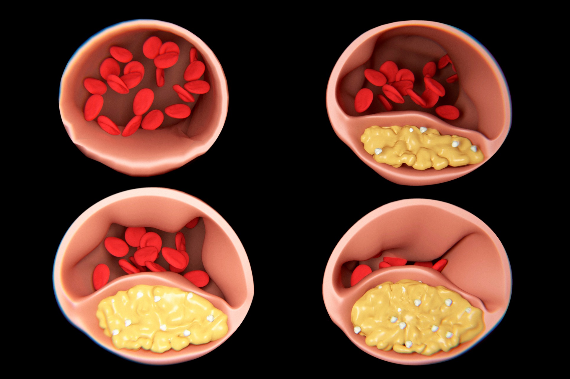 Polyneuropathie Axonale Sensitivo Motrice Des Membres Inférieurs Forum Les neuropathies périphériques - Symptômes et traitement - Doctissimo