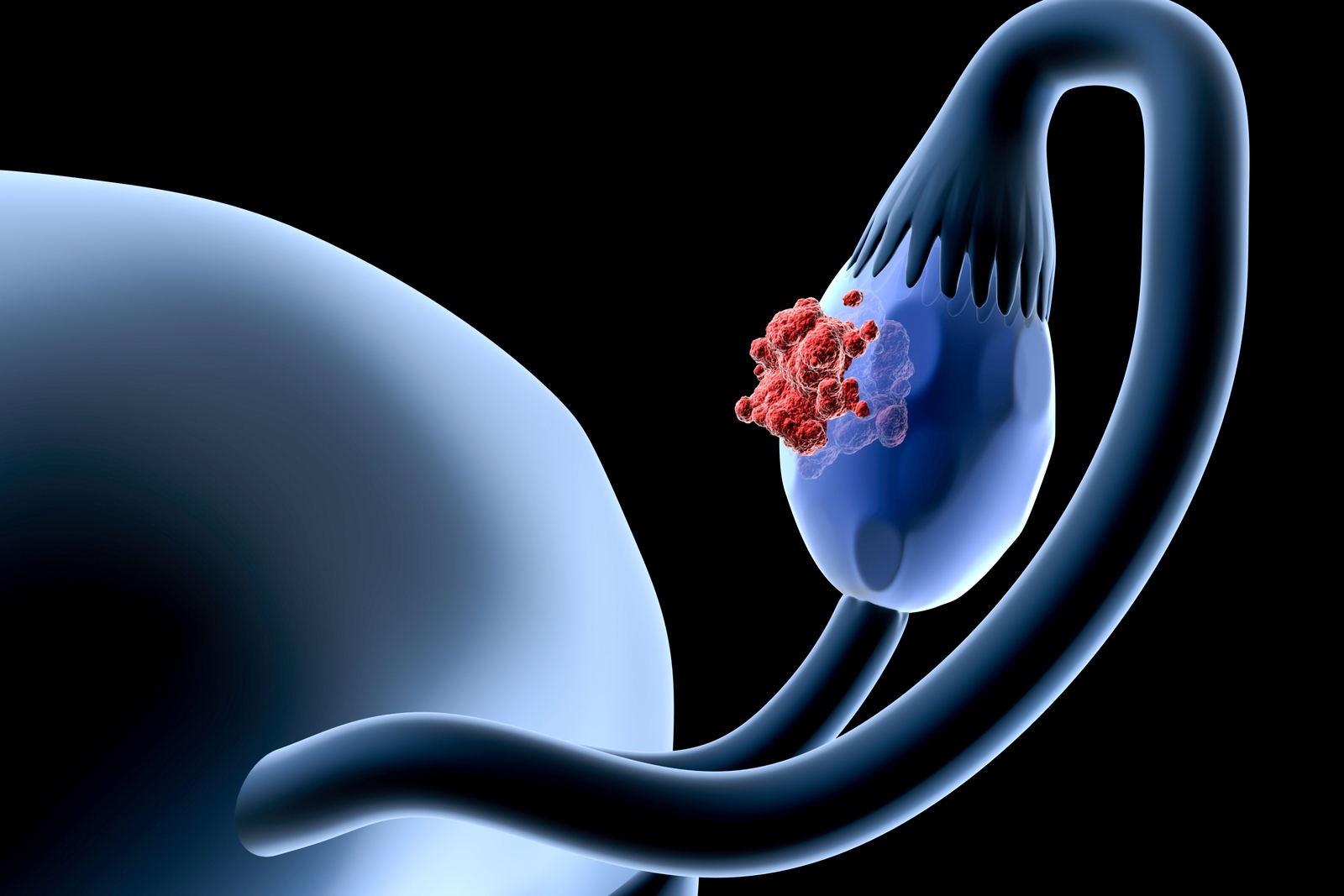 Cancer de l'ovaire : attention aux traitements hormonaux - Doctissimo