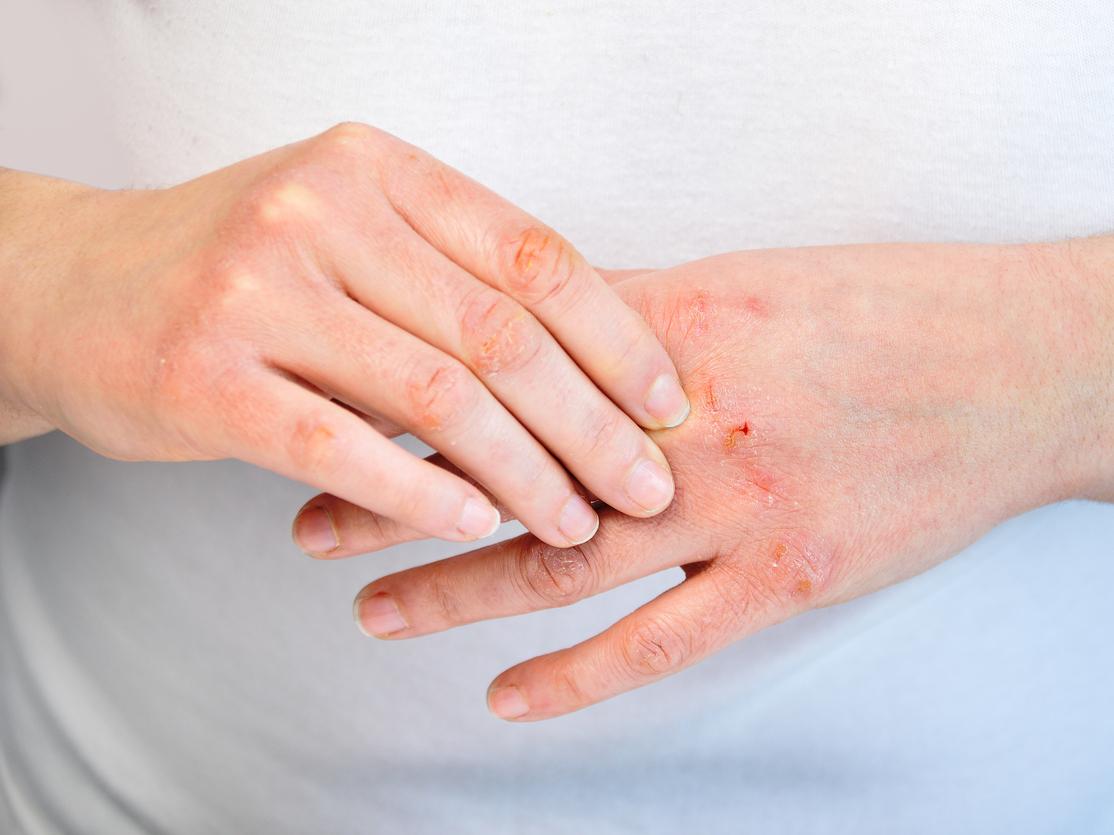 Eczéma allergique des aisselles : quels traitements ?
