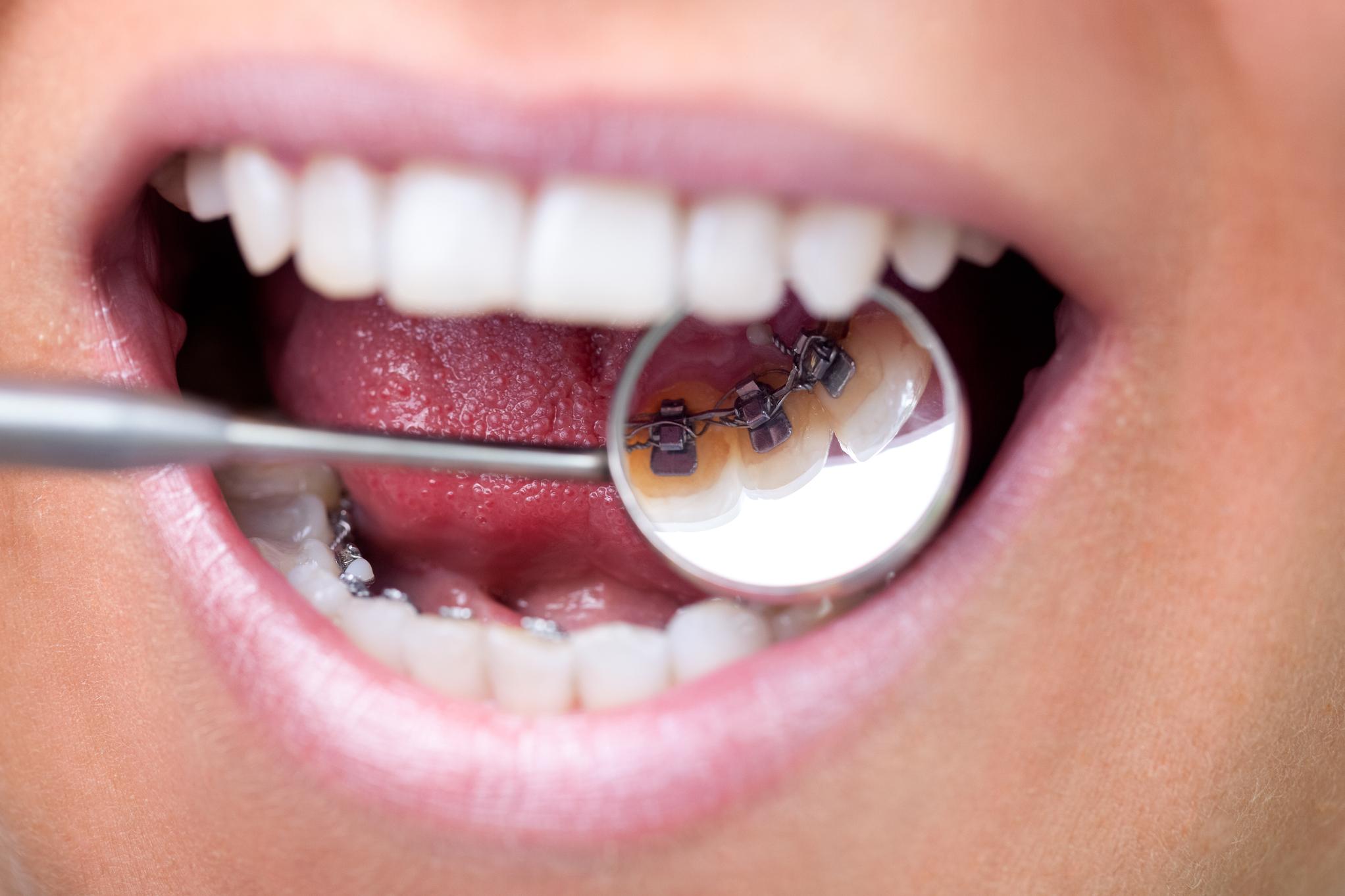 Appareil dentaire de nuit : à quoi sert une gouttière ?