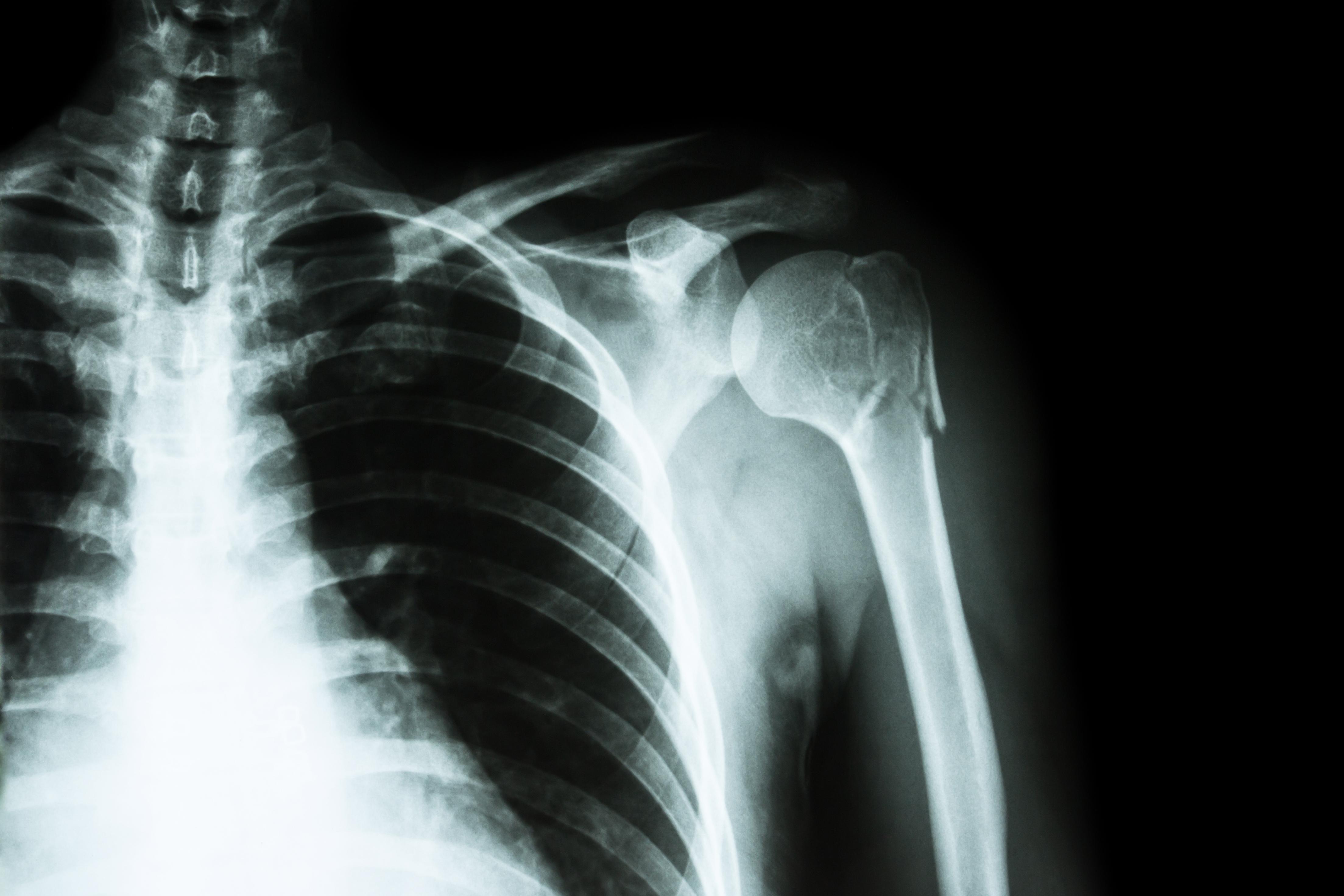 Radiographie pulmonaire - Définition, intérêt, déroulement de l ...