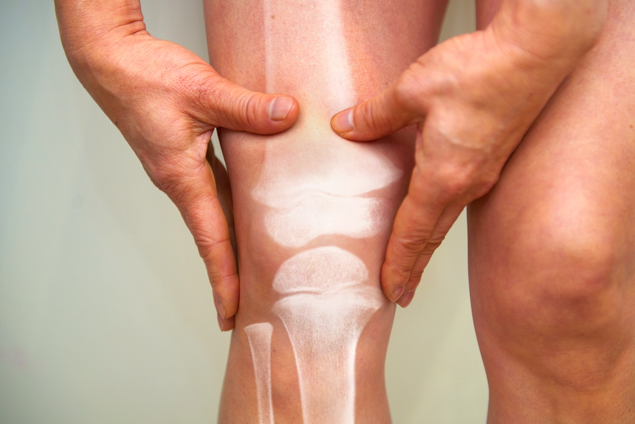 L'arthrose : Causes, Symptômes, Prévention et Traitement de l'arthrose
