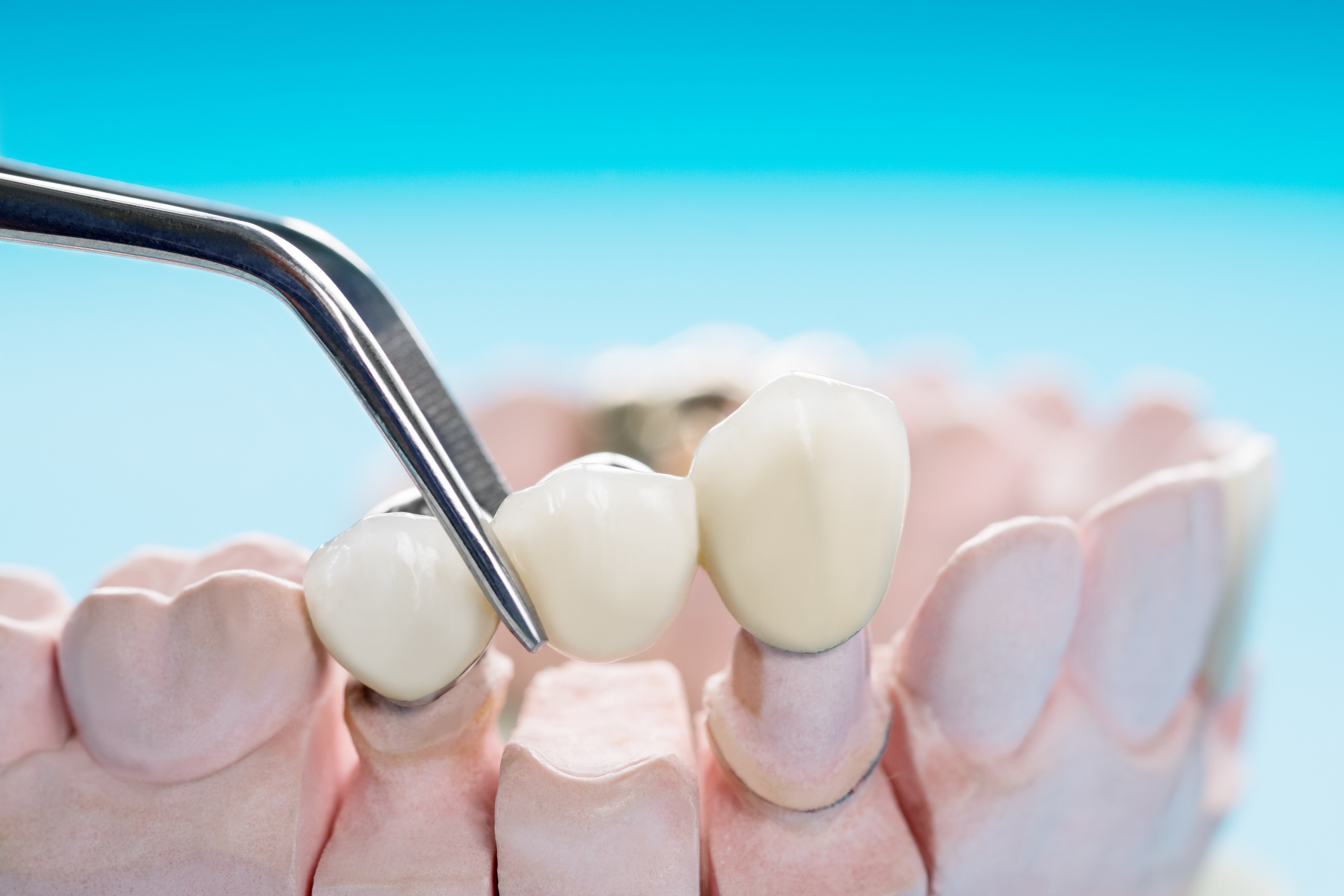 Dentier provisoire - Centre Implant Maurice clinique dentaire