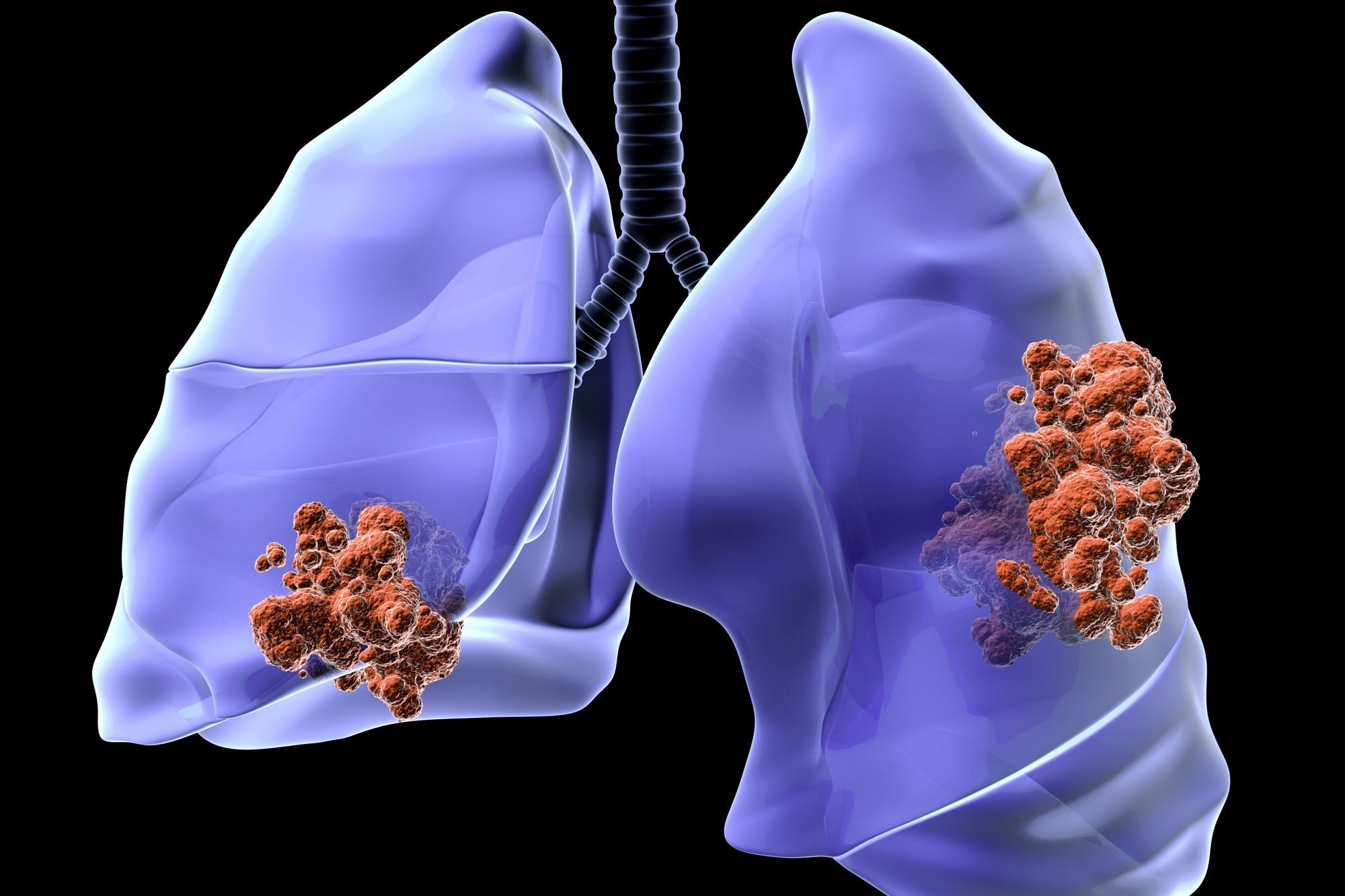Nodule pulmonaire : est-ce forcément un cancer ?