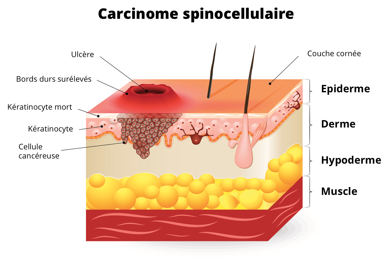 carcinome spinocellulaire