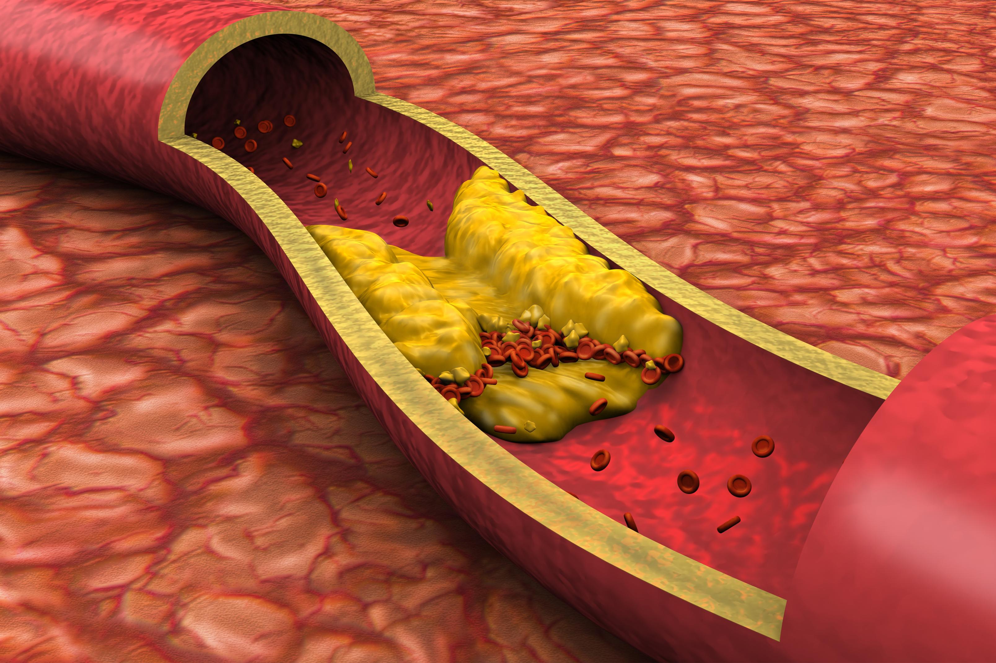 Cholestérol total : comment interpréter les résultats ?