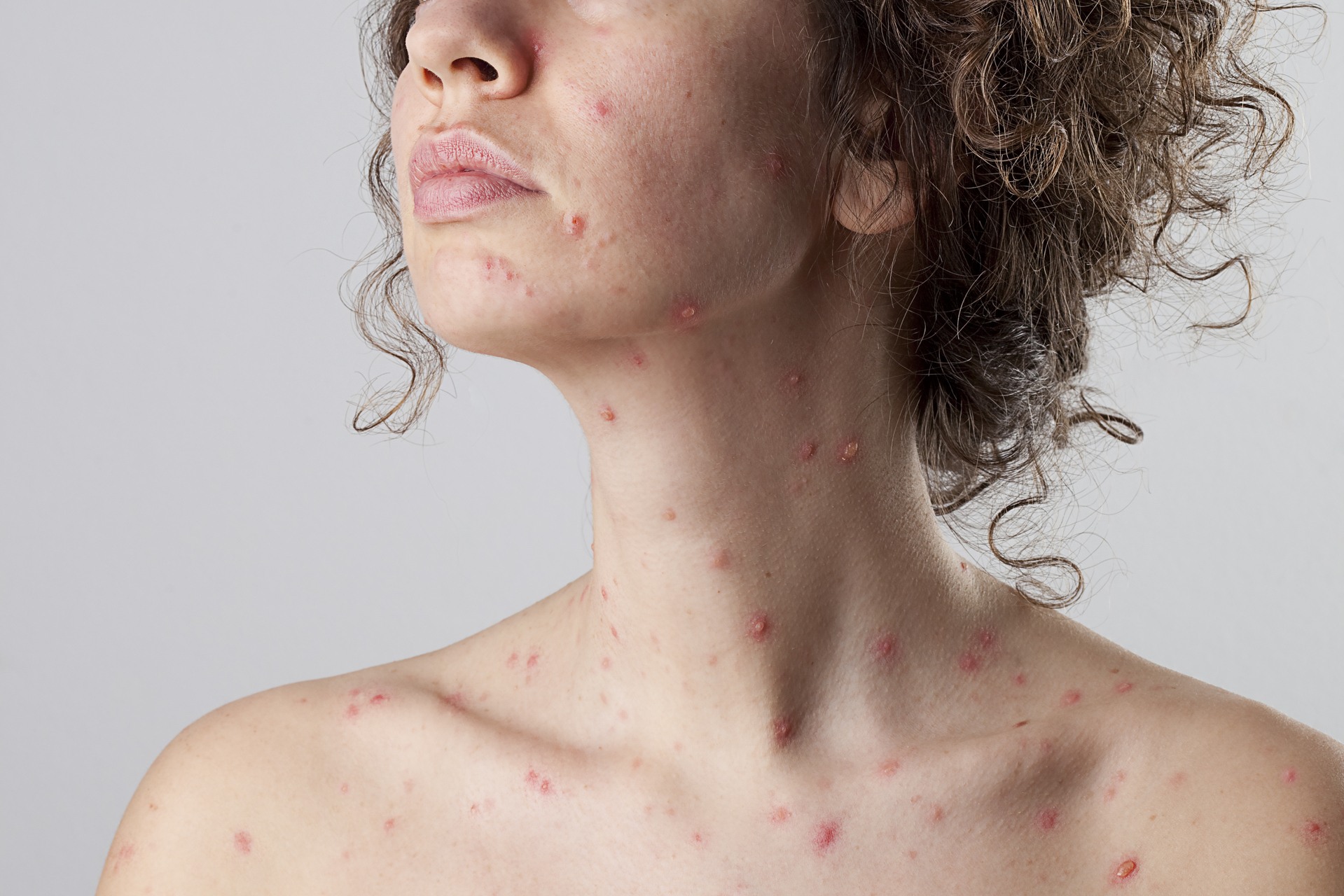 La varicelle chez l'adulte : les risques de l'âge