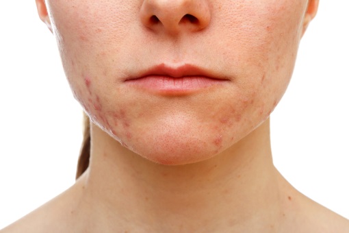 Cicatrices d'acné : les traitements - Doctissimo