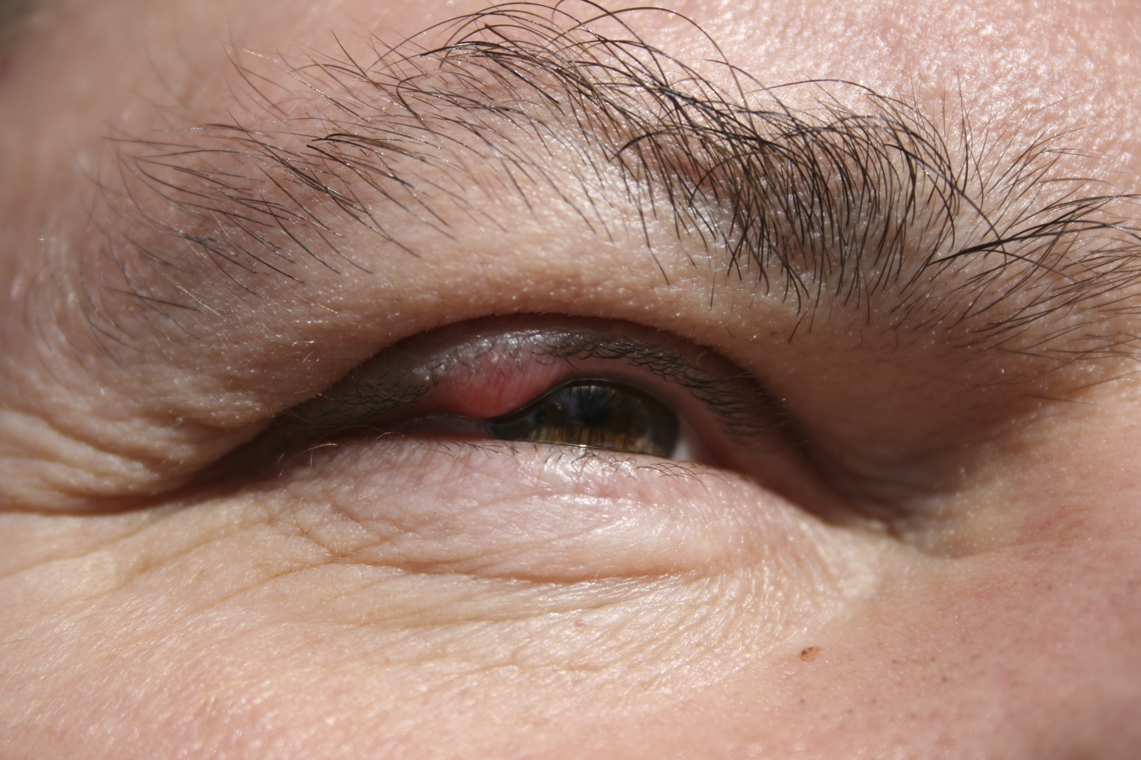 Un homme découvre qu'il a une écharde dans l'oeil depuis 15 ans