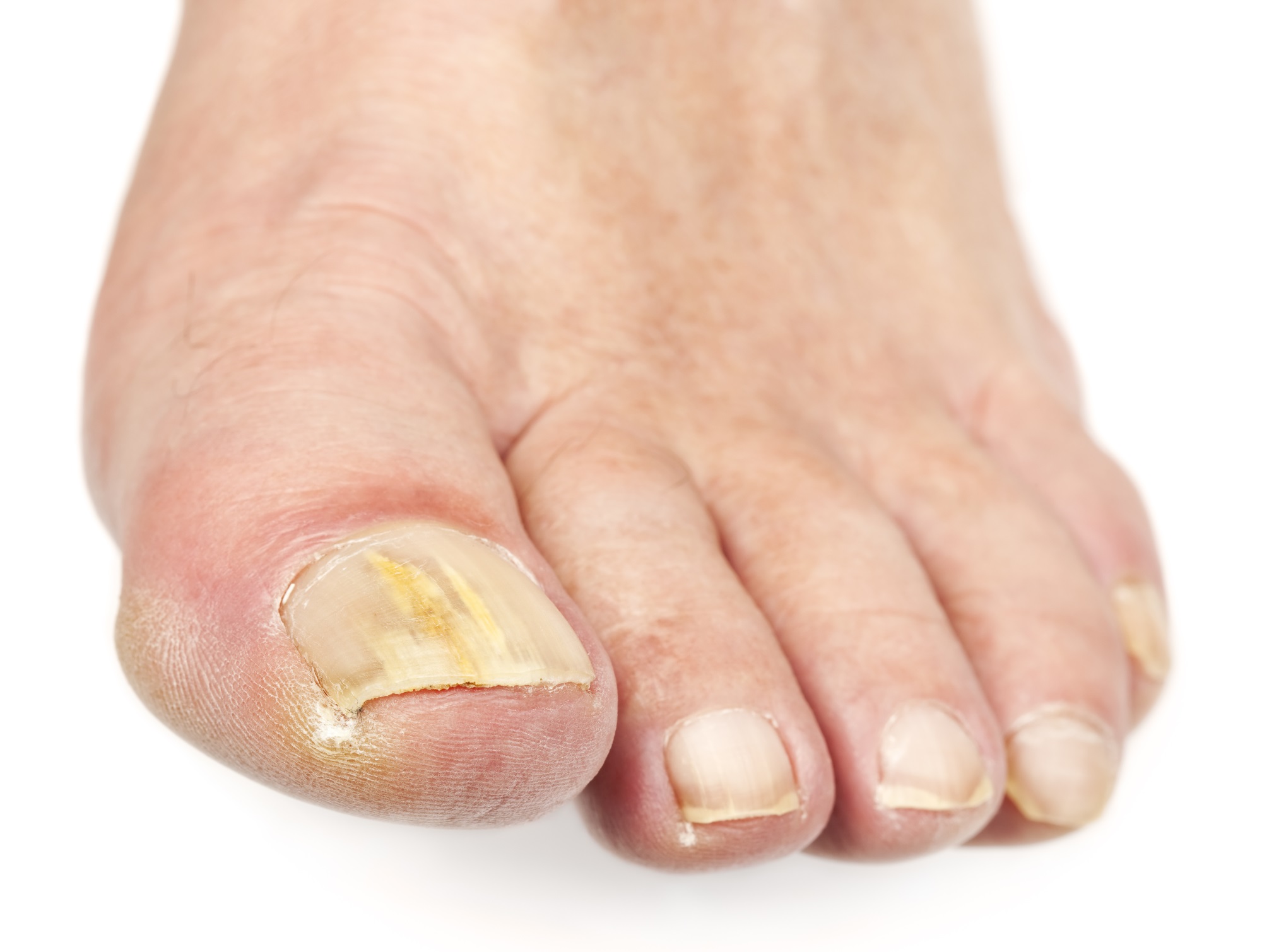 Mycose des ongles de pieds : symptômes, que faire ?