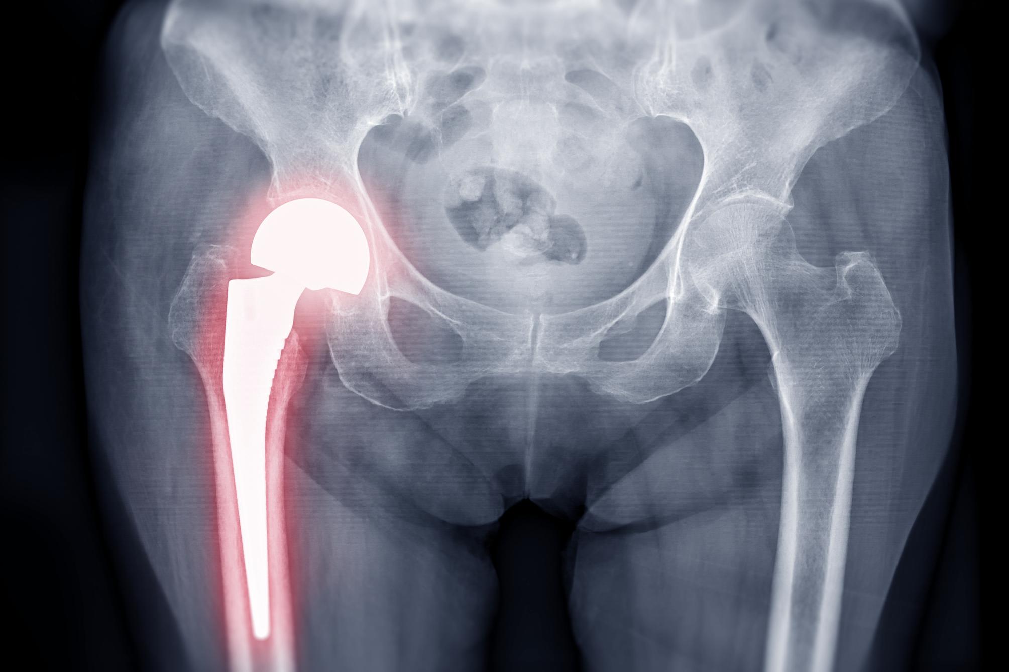 Arthrose de hanche : diagnostic et traitements