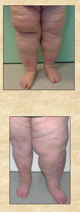 Maladie des jambes poteaux (lipœdème) : des solutions existent pour contrer  ses effets indésirables