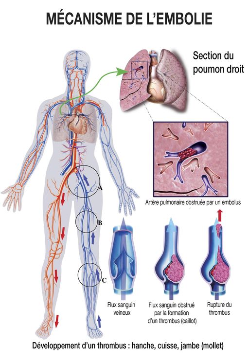 Mécanisme de développement d'un thrombus : hanche, cuisse, jambe (mollet)