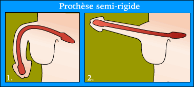 Prothèse semi-rigide