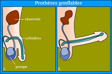 Prothèses gonflables