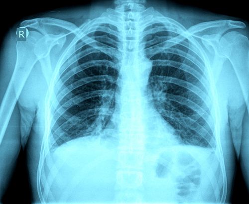 Radiographie pulmonaire - Définition, intérêt, déroulement de l ...