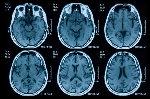 Scanner cérébral - Définition et déroulé de l'examen - Doctissimo