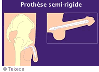 Les prothèses semi-rigides