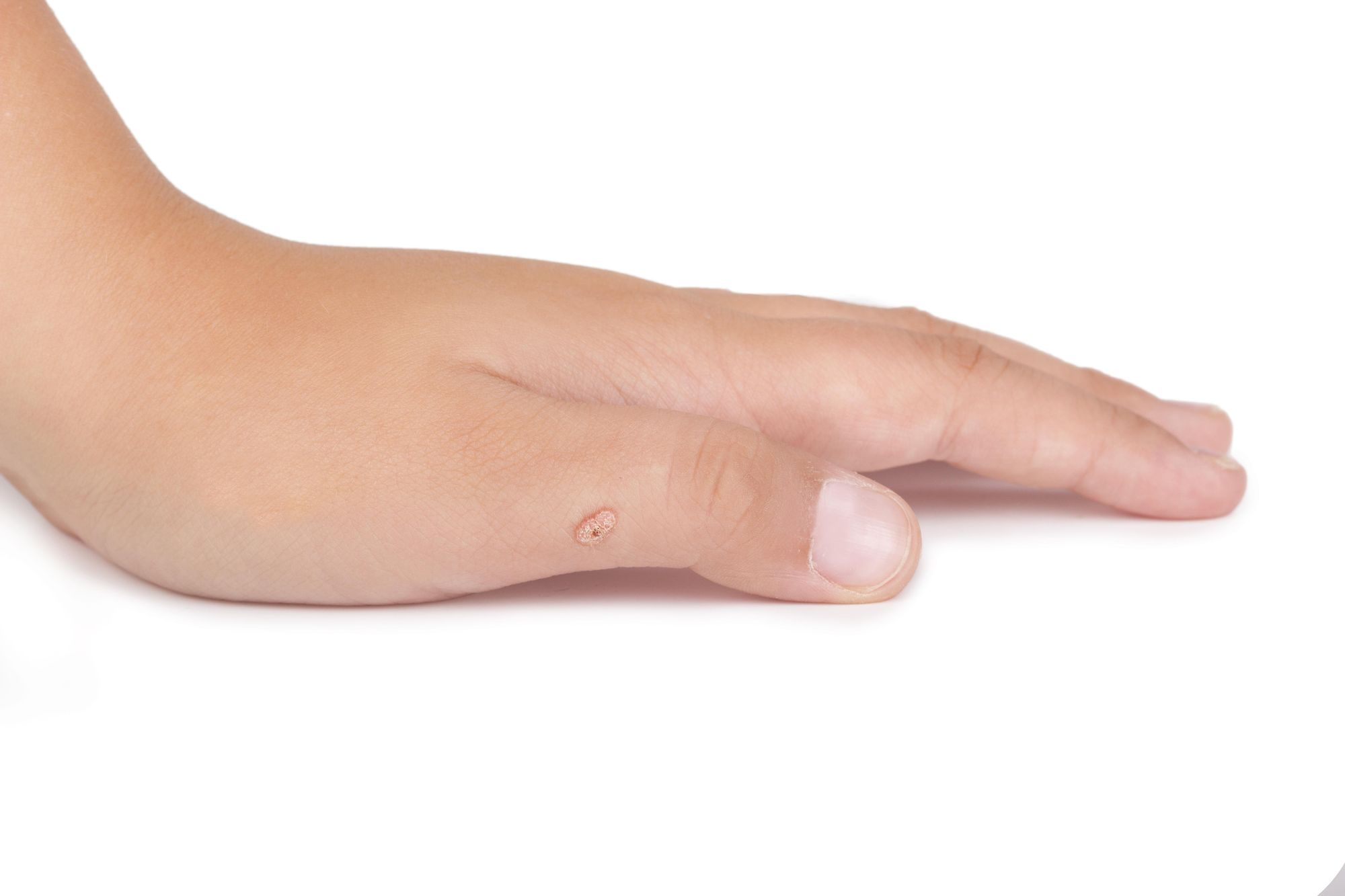 Verrue de la main : symptômes, causes et traitements