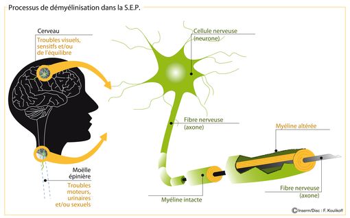 La sclérose en plaques (SEP) : symptômes et traitement
