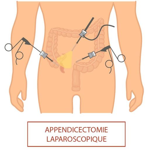 Appendicite de l'adulte : symptômes et traitements