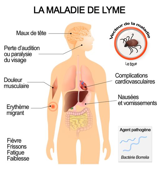 Symptômes et complications de la maladie de Lyme
