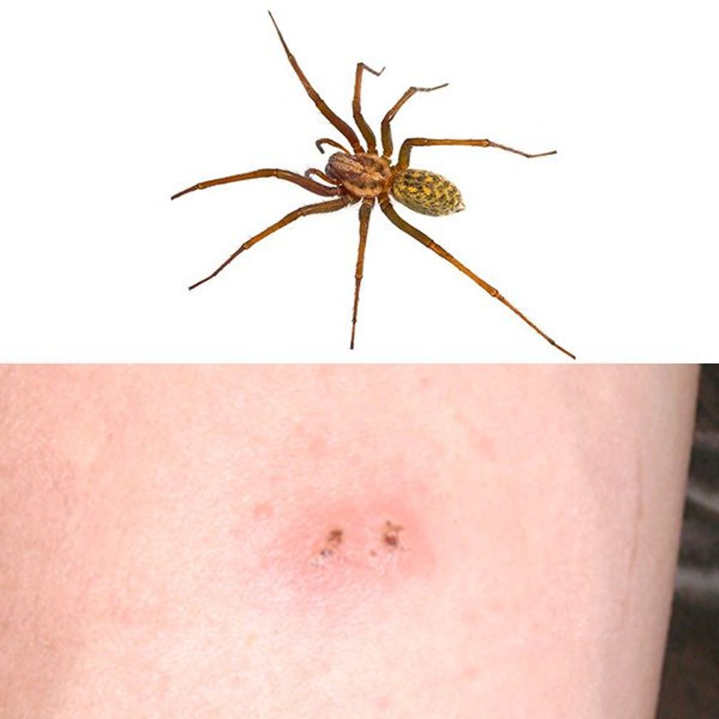 Piqûre d'araignée : symptômes, photo, cloque, que faire ?
