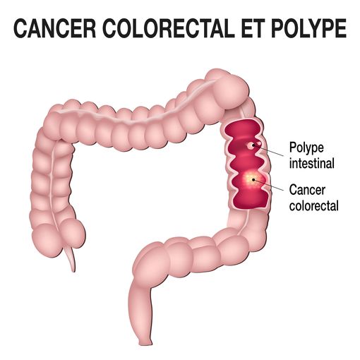 Polype colorectal : symptômes, traitement, cancéreux ?