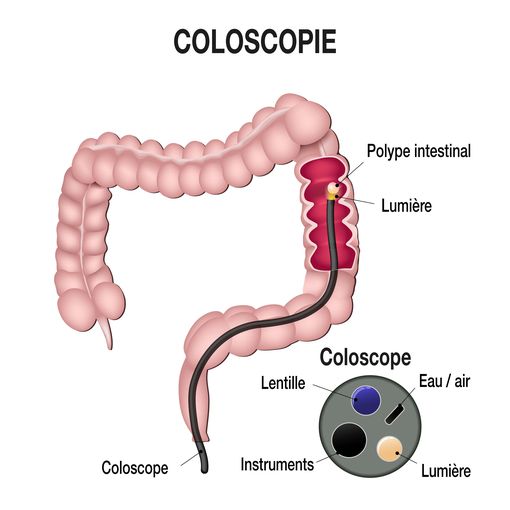 Polype colorectal : symptômes, traitement, cancéreux ?