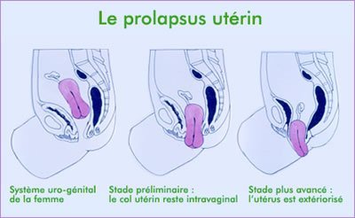 Prolapsus utérus