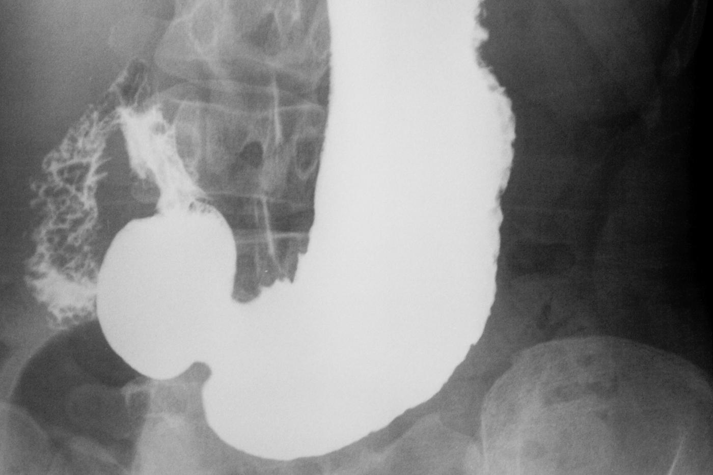 Скопия пищевода. Контрастирование желудка рентген. Рентген желудка с барием язва. Рентгеноскопия желудка с барием язва желудка. Рентгеноскопия желудка норма.