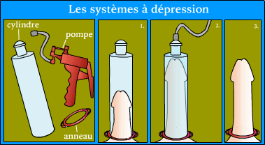 Systèmes à dépression