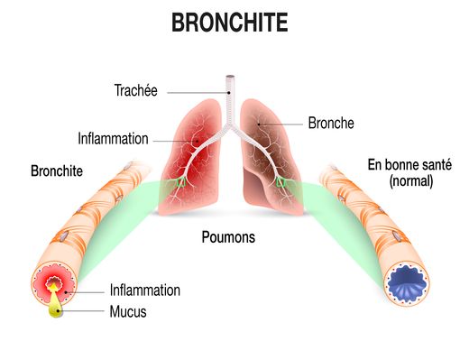Remèdes et astuces contre la bronchite - Conseils santé