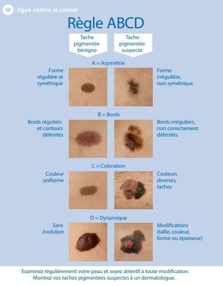 Grain de beauté et cancer de la peau (mélanome)