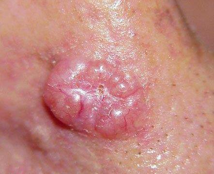Les symptômes du cancer de la peau - Reconnaître les signes qui ...