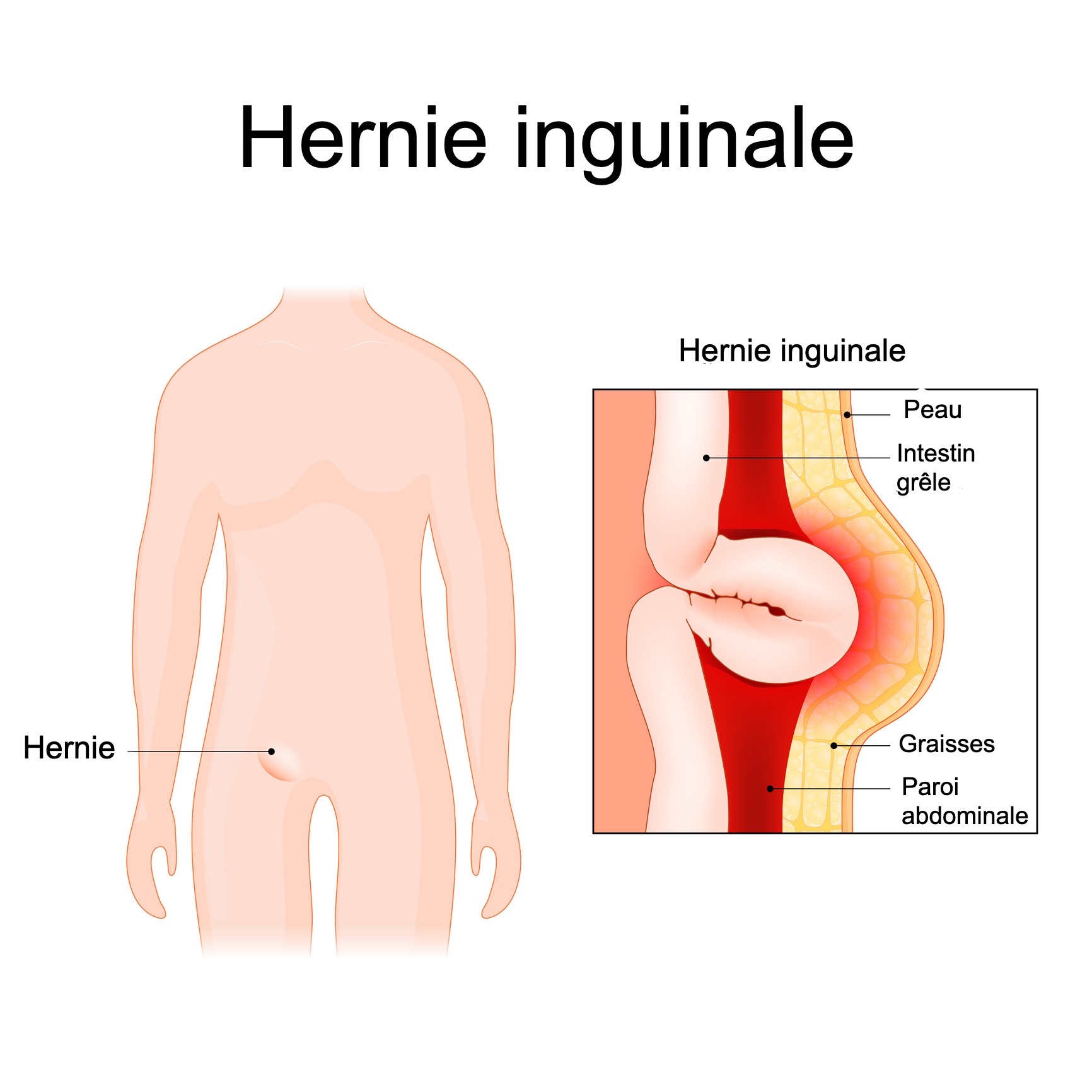 Hernie inguinale : causes, symptômes et opération