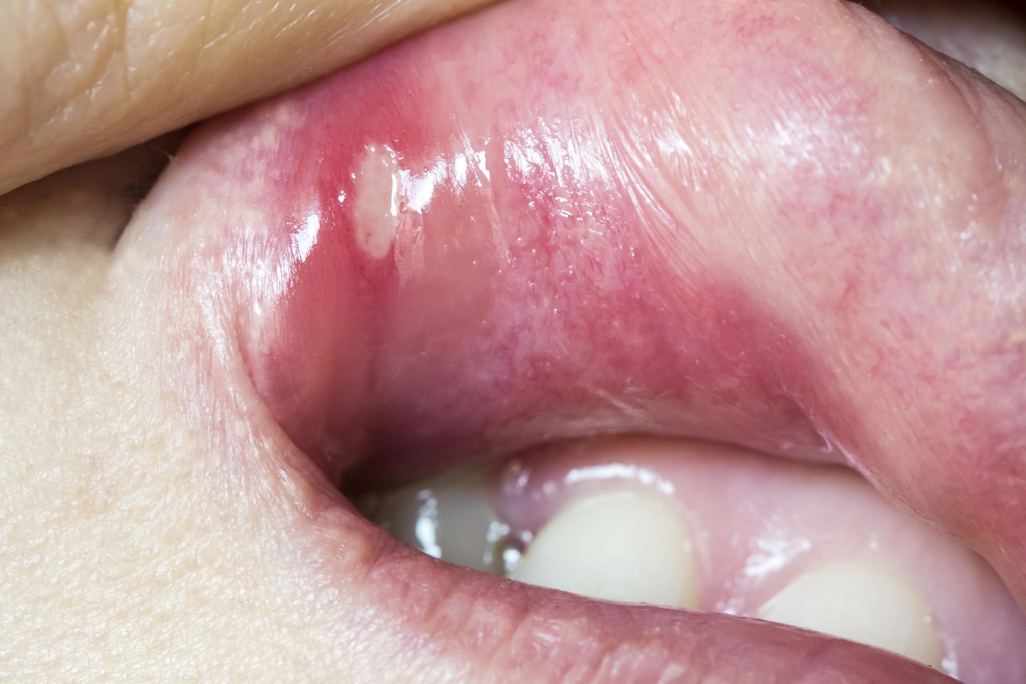 Homéopathie et problèmes de bouche - Doctissimo