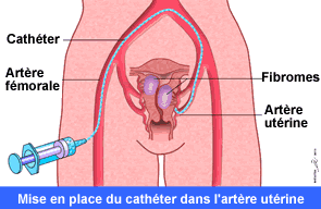 Mise en place du cathéter dans l'artère utérine