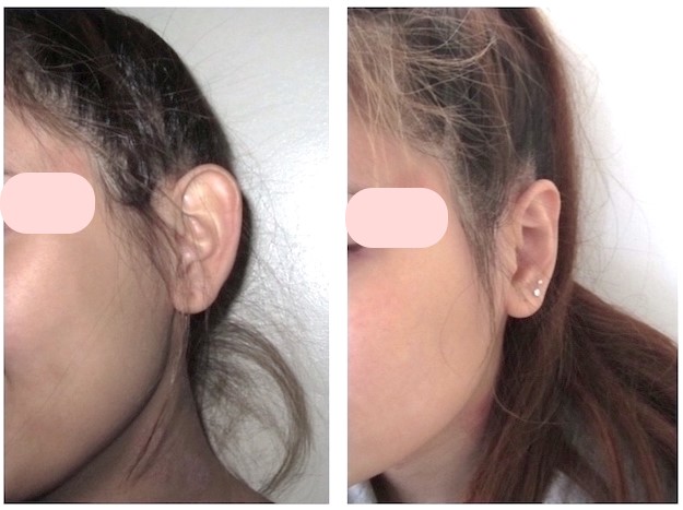 Otoplastie : la chirurgie des oreilles décollées