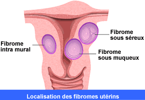 Localisation des fibromes utérins
