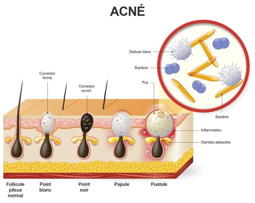 Homéopathie et acné - Doctissimo
