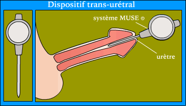 Dispositif trans-urétral