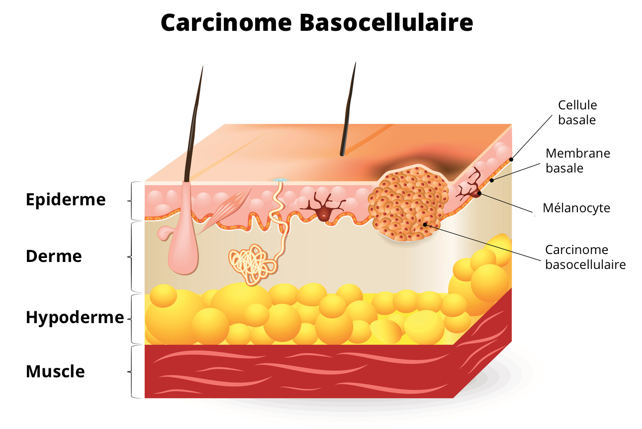 carcinome basocellulaire