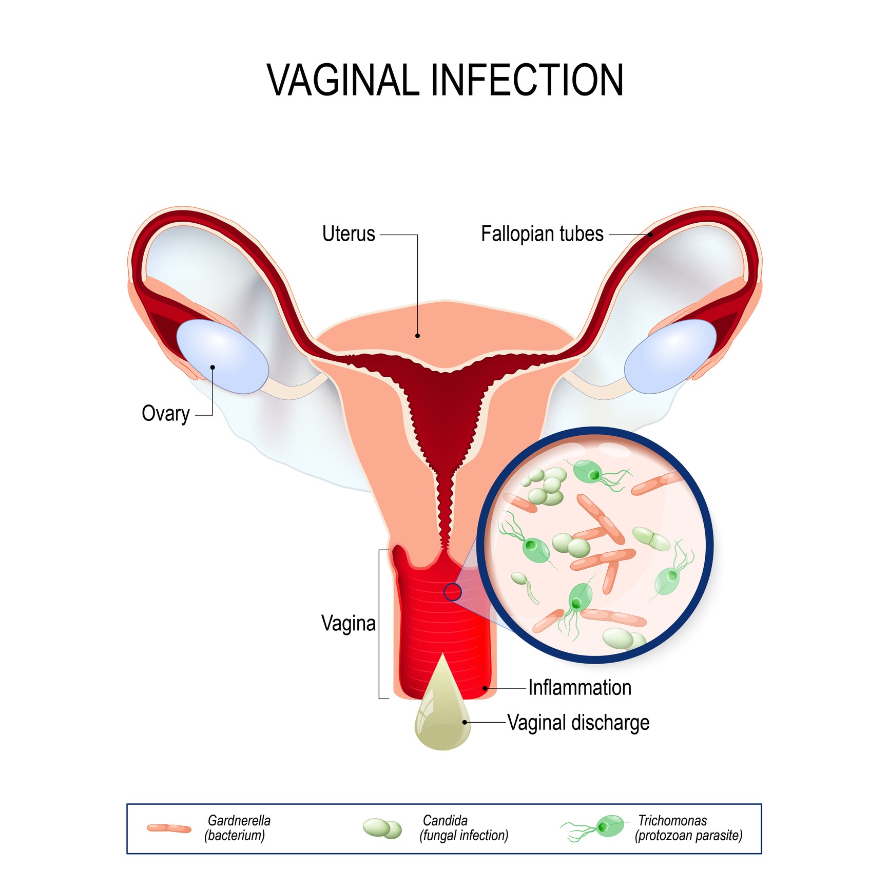 Vaginite : Causes, symptômes et traitement