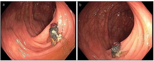 Une mouche intacte découverte dans le colon d'un patient
